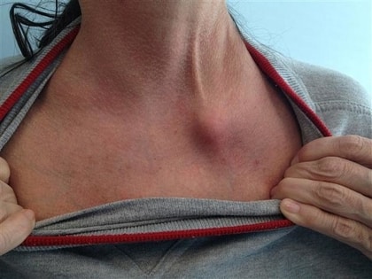 Cracked Sternum 4 Causes 6 Symptoms And 9 Treatments Cracked Sternum 4 Causes 6 Symptoms And 9 Treatments